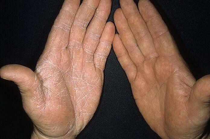 gomba tünetei a kéz bőrén