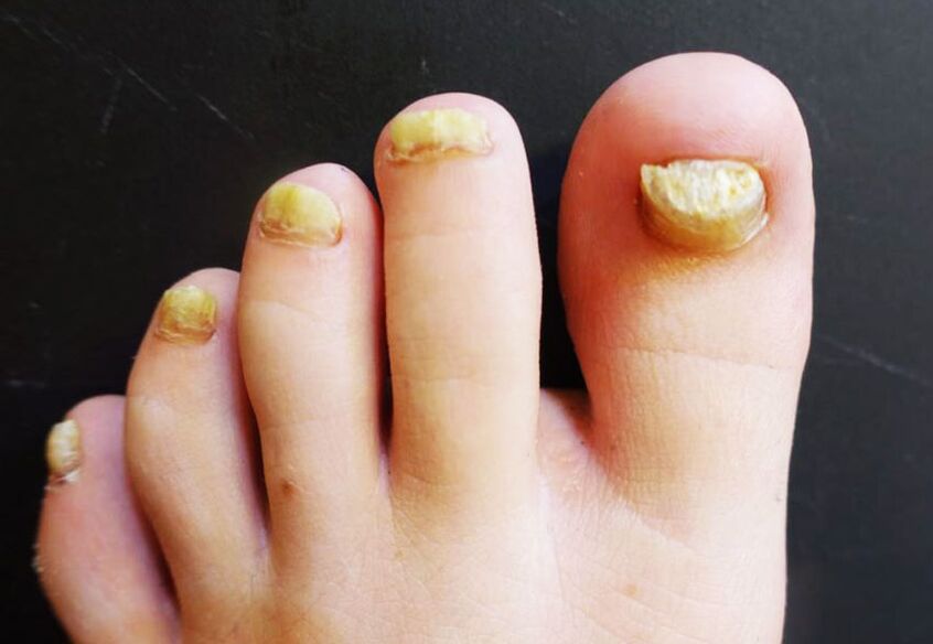 A gombásodás által érintett lábkörmök csúnya megjelenése