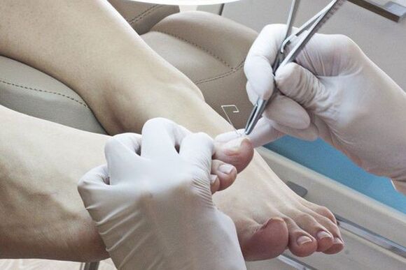 A gomba kezelése a lábak körmeiről