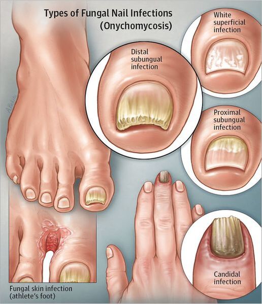 gomba nail foot következményeik
