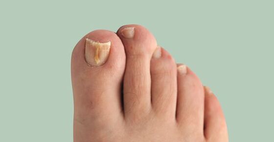 gomba nail foot tünetei)