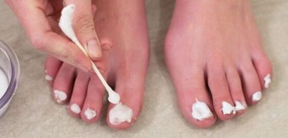 a kezelés a népi módszerrel nail gomba köröm gombás lábakon milyen gyorsan fejlődik