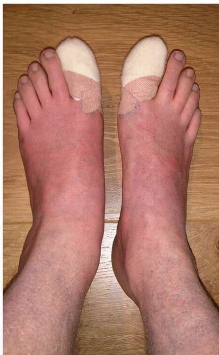 A lábgomba tünetei | Canesten