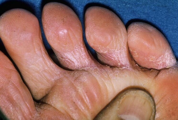 gomba nail lábápolás származó zozh